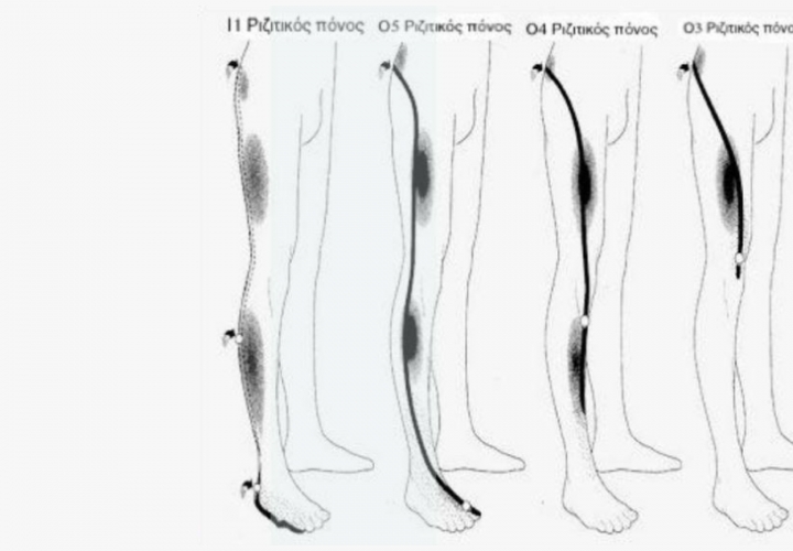 Κοινά πρότυπα κατανομής πόνου ριζίτικης αιτιολογίας στο πόδι